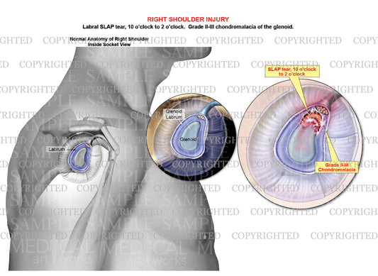 Labral SLAP tear - Glenoid chondromalacia grade 2-3