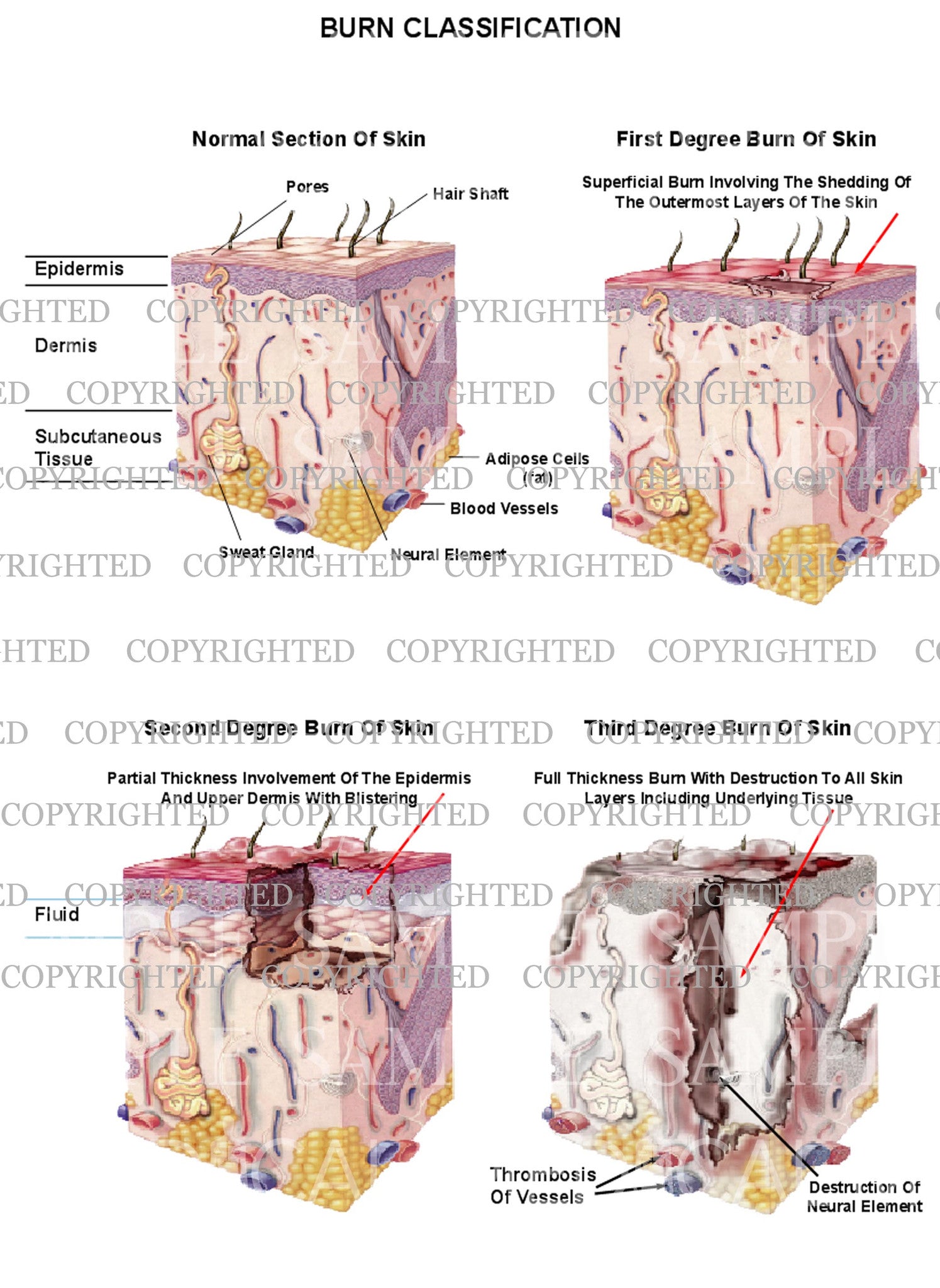 Burn Grading System Burn classification chart – Medical Art Works
