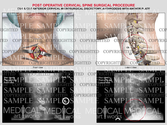 C5-6 & C6-7 anterior cervical microsurgical discectomy and fusion with post-op xrays