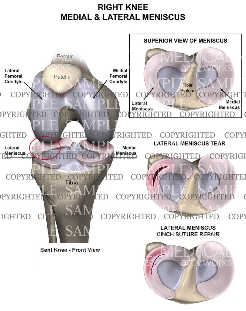 Knee meniscus tear and repair