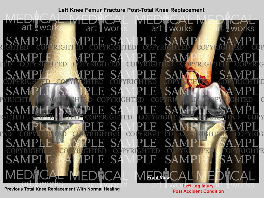 Left Knee Femur Fracture Post-Total Knee Replacement
