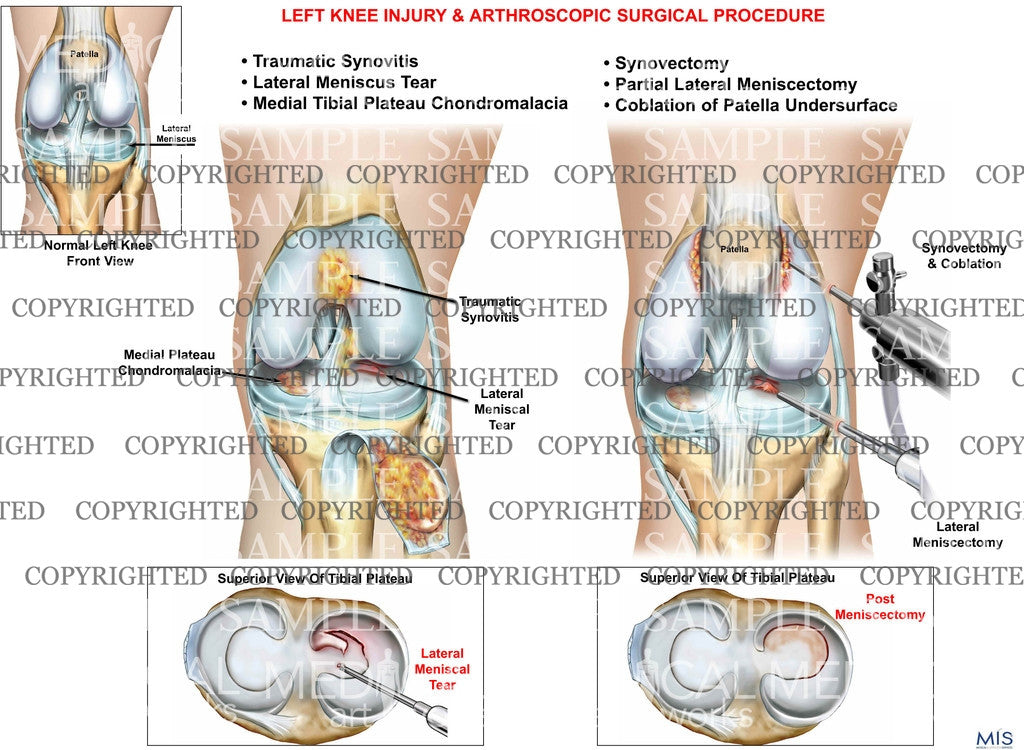 Left knee injury and arthroscopic surgical procedure
