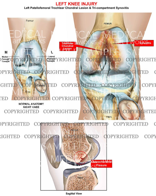 Left Knee InjuryLeft Patellarfemoral Trochlear Chondral Lesion & Tri-compartment Synovitis