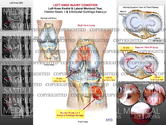Left Knee medial & lateral meniscal tear, patellar articular cartilage damage