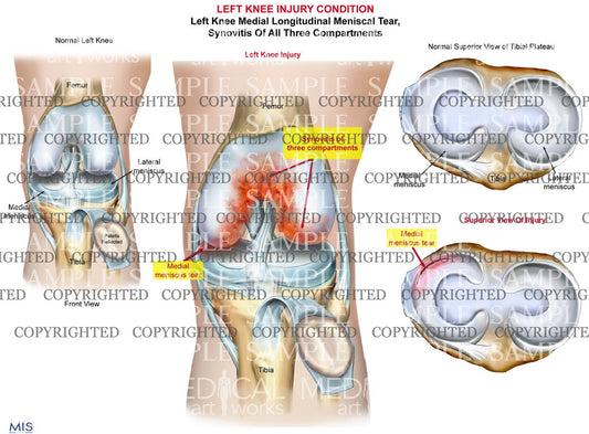 Left Knee Injury - Meniscal tear - Synovitis