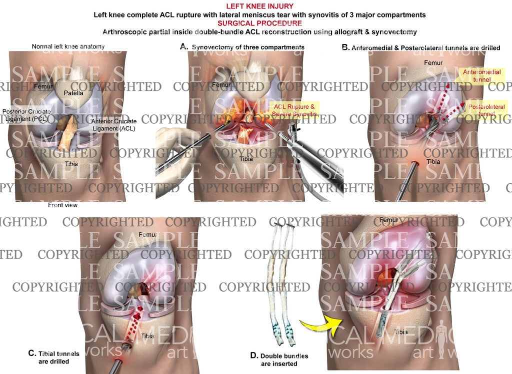 Arthroscopic partial inside double-bundle ACL reconstruction