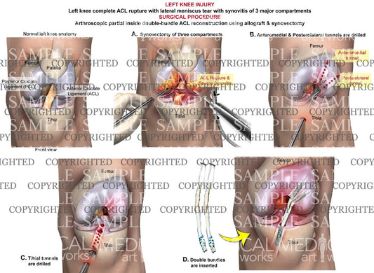 Arthroscopic partial inside double-bundle ACL reconstruction