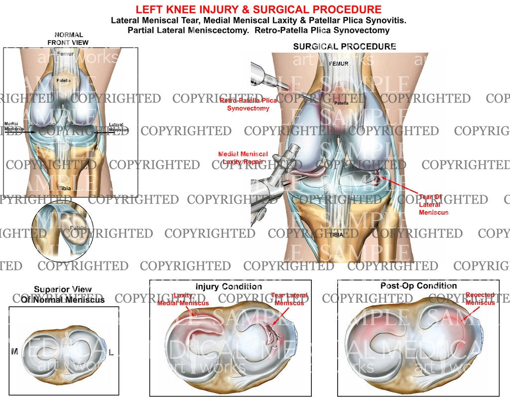 Left knee injury and surgical procedure