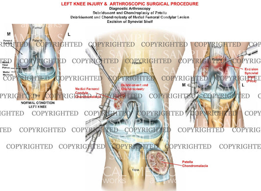 Left Knee arthroscopic procedure