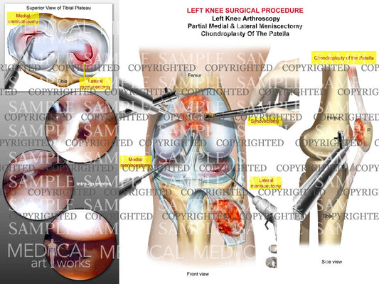 Left Knee Arthroscopy - Meniscectomy - Chondroplasty
