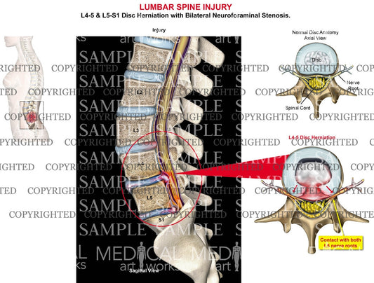2 level - L4-5, L5-S1 Lumbar disc herniations